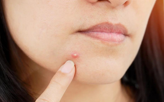 5 MYTHS ABOUT PIMPLES - Dr Anvika