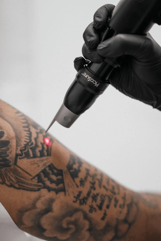 Laser Tattoo Removal - Dr Anvika