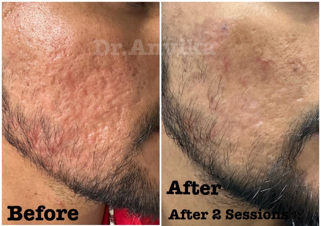 Acne Scar Reduction with Laser & Dermabrasion