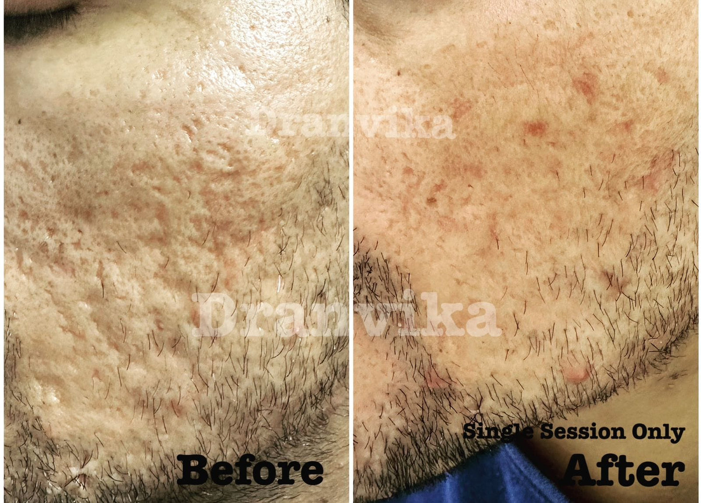 Acne Scar Reduction with Laser & Dermabrasion