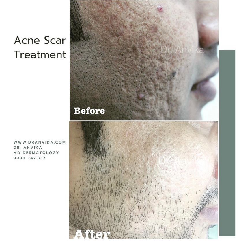 Acne Scar Reduction with Laser & Dermabrasion