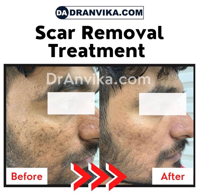 Acne Scar Reduction with Laser & Dermabrasion