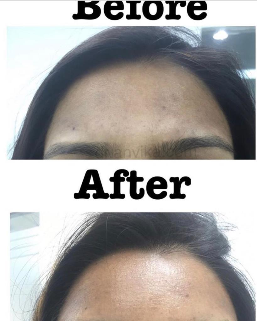 Skin Glow : Vampire Facial (Microneedling & PRP) and Laser Toning(ND:Yag Q Switched Laser )