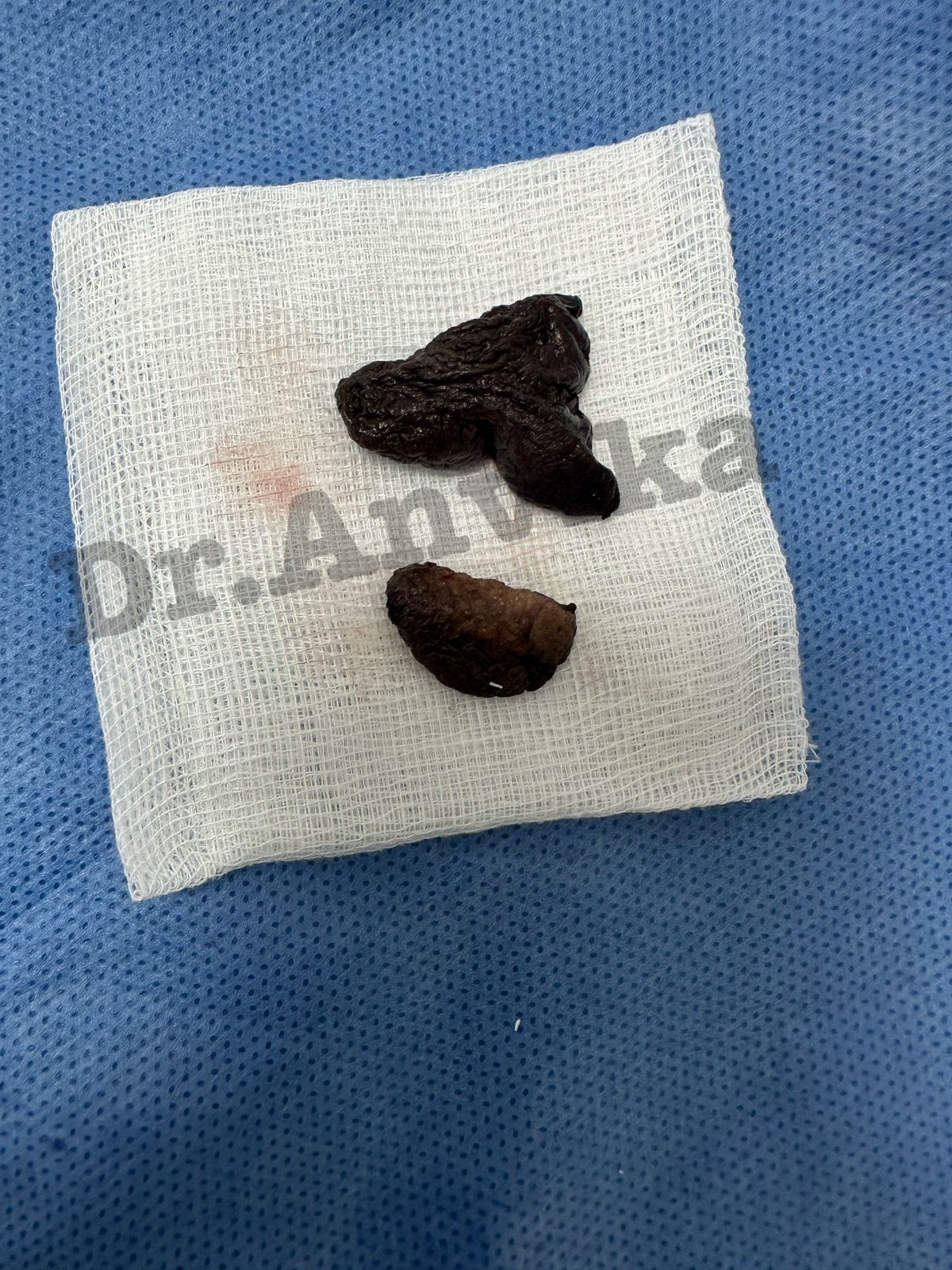 Labioplasty