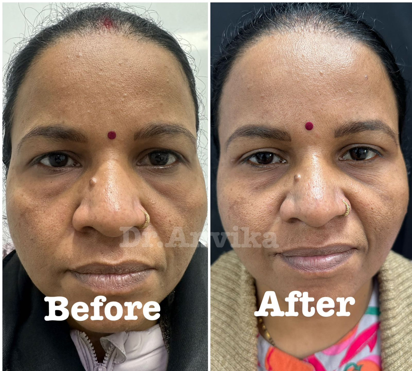 Blepharoplasty and Under Eye Bag Removal