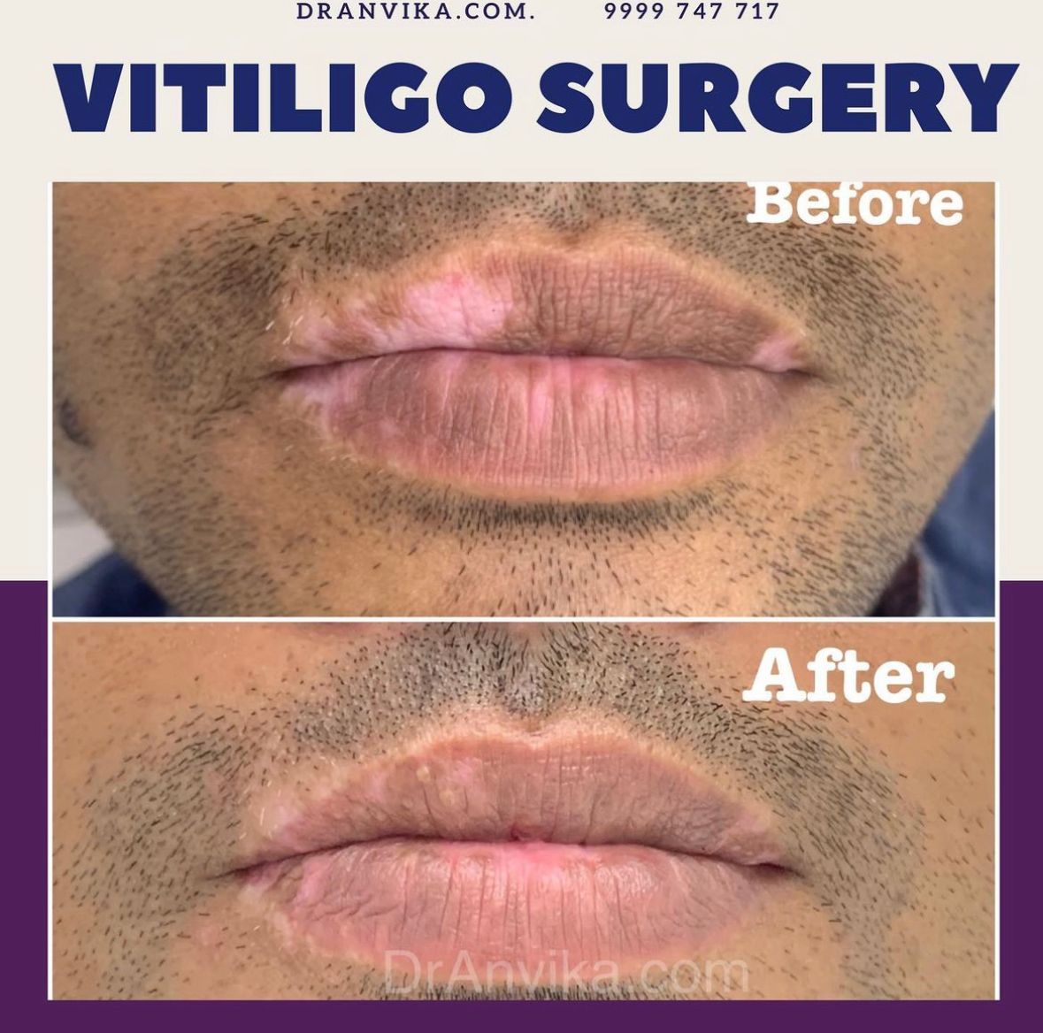 Vitiligo Surgery