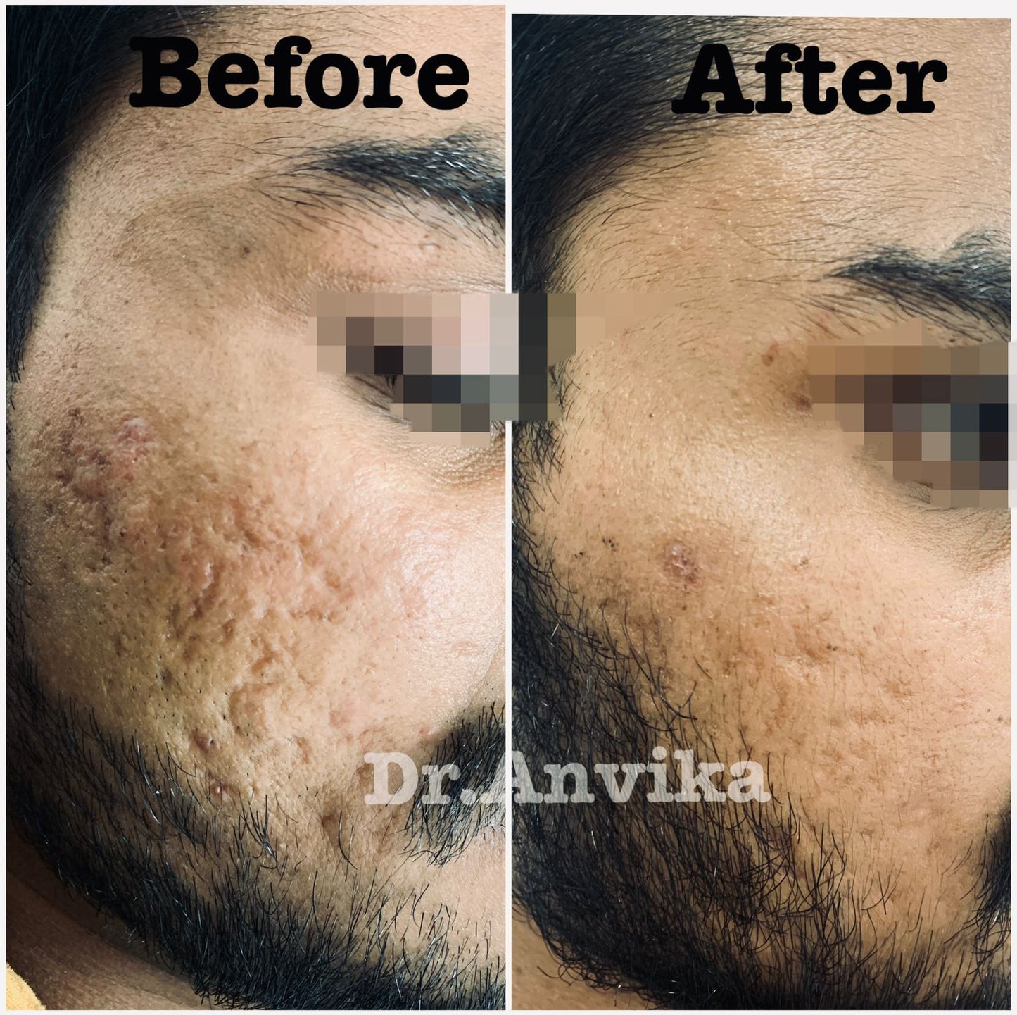 Acne Scar Reduction with Laser & Dermabrasion