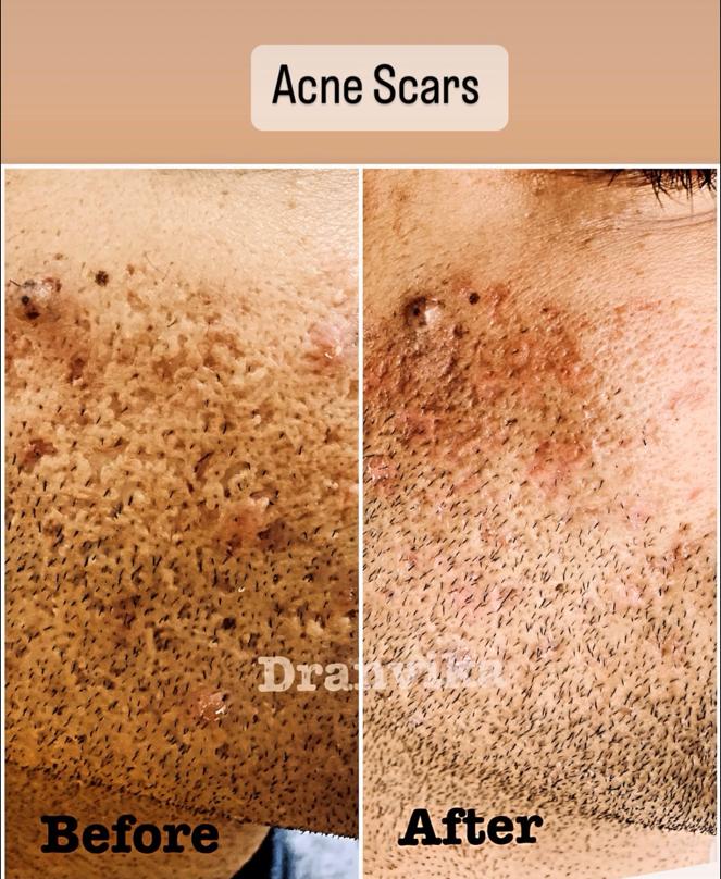 Acne Scar Reduction with Laser & Dermabrasion