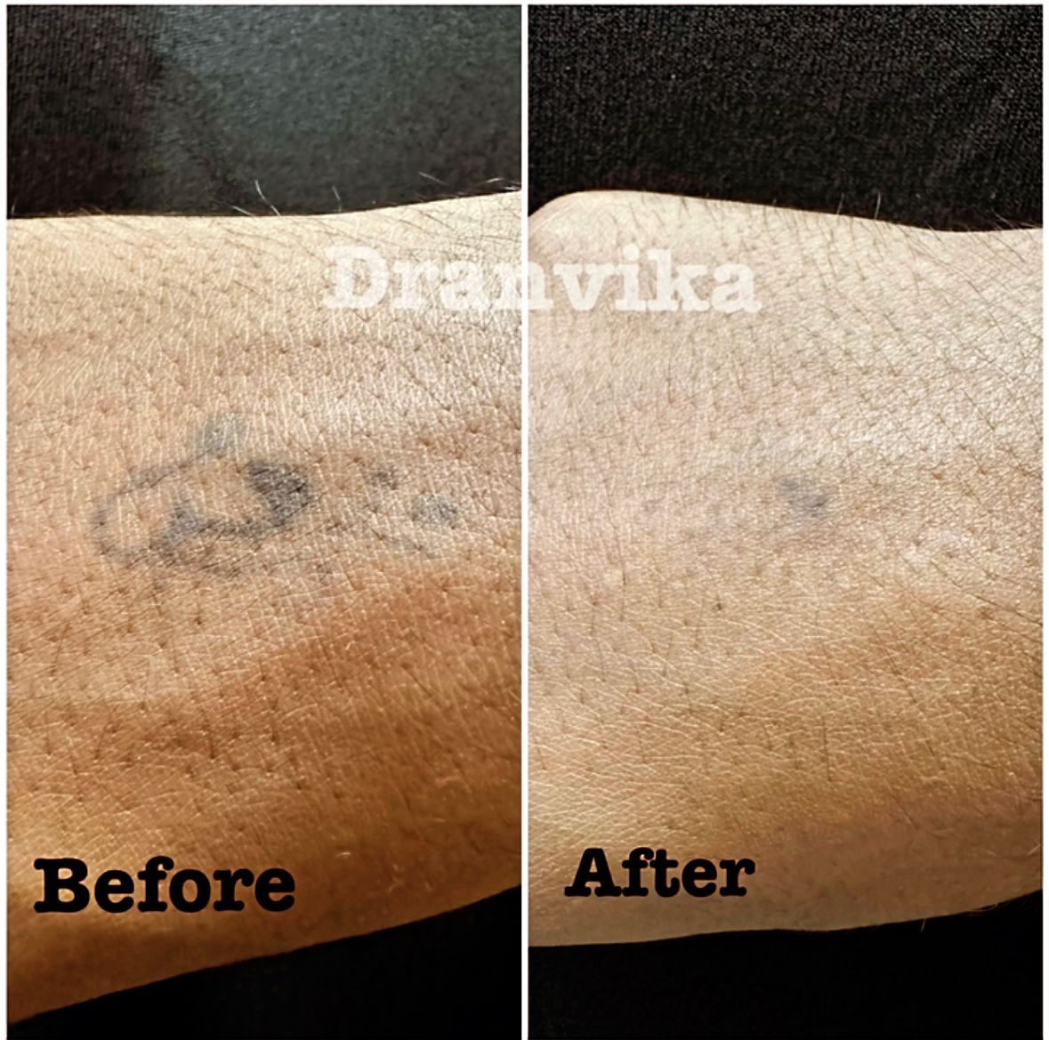 Laser Tattoo Removal