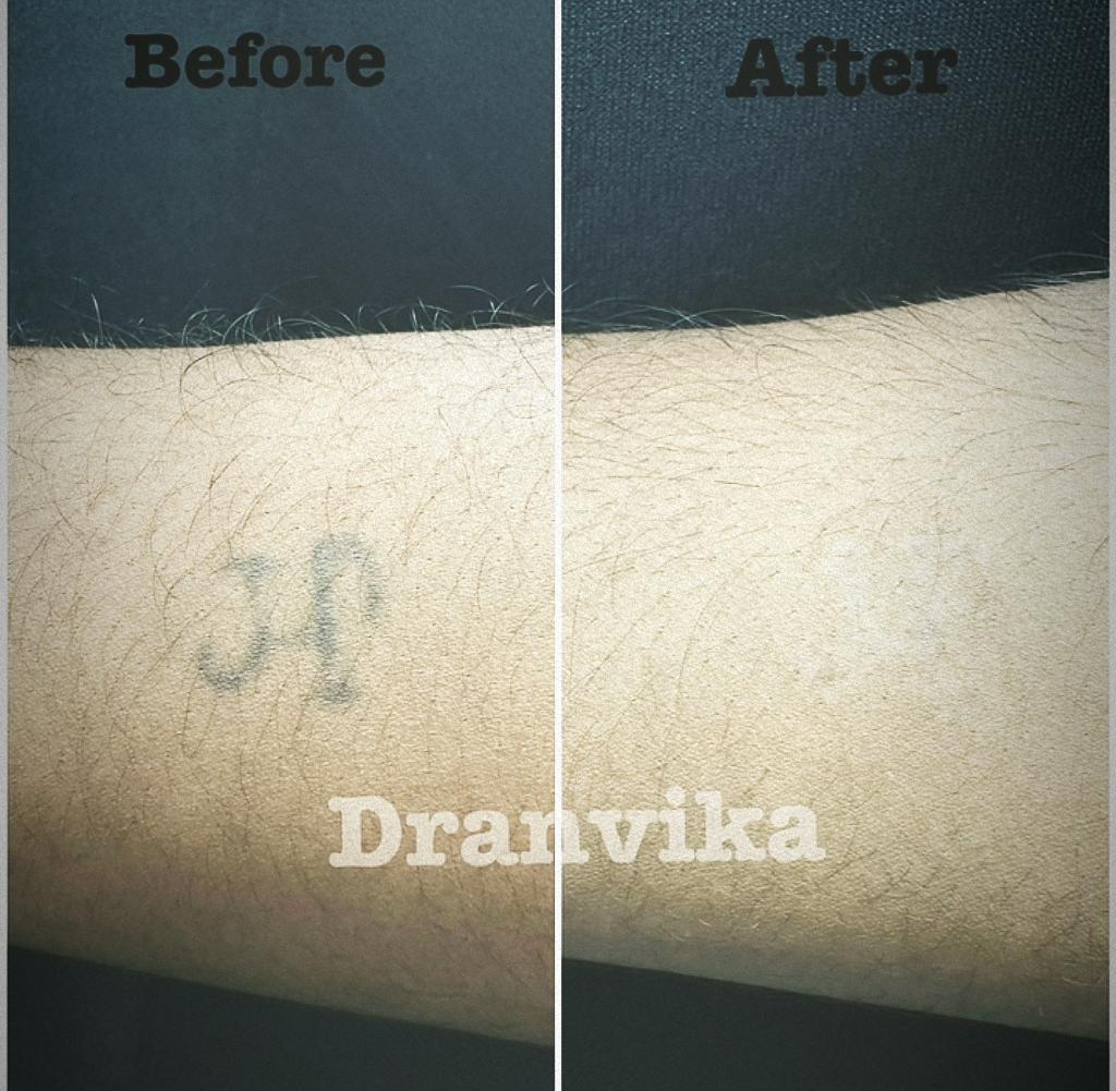 Laser Tattoo Removal