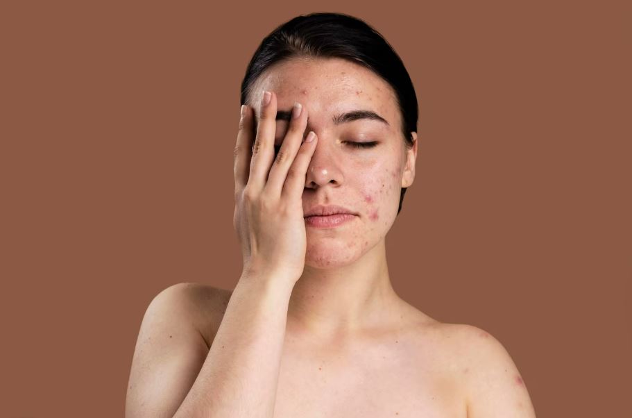 7 Ways in Which Stress Affects Your Skin