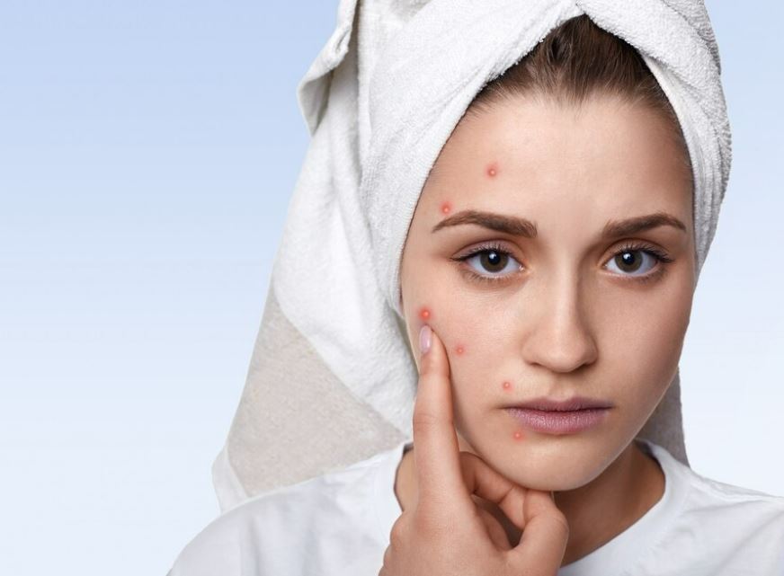 Say Goodbye to Acne: Easy Steps to Clear Skin
