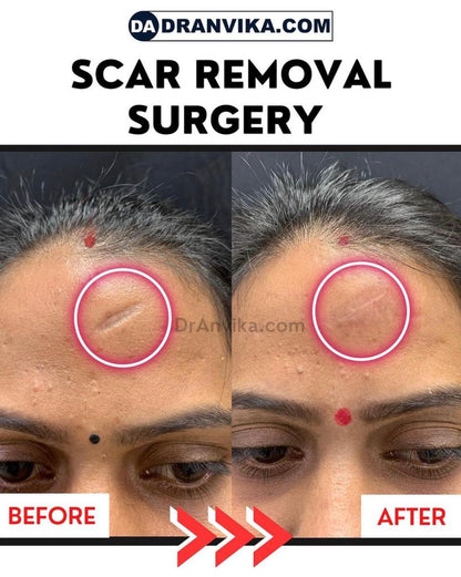Scars - Stretch marks, Trauma scars reduction with Laser or Surgery