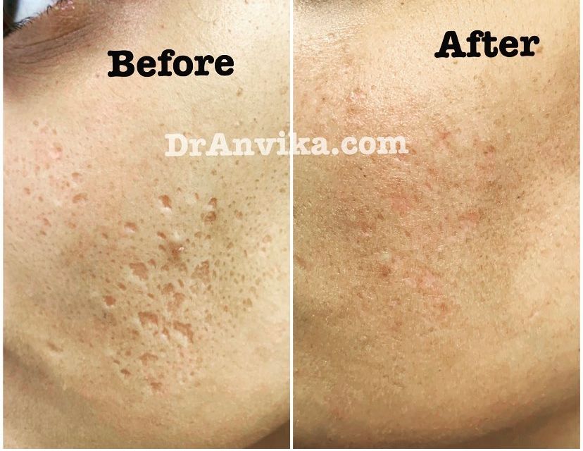 Acne Scar Reduction with Laser & Dermabrasion
