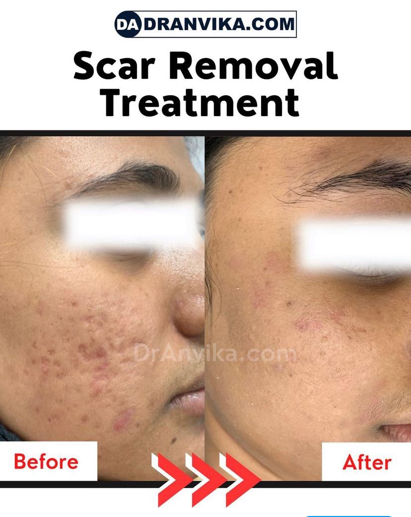 Acne Scar Reduction with Laser & Dermabrasion