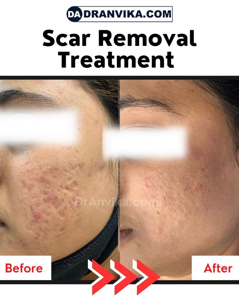 Acne Scar Reduction With Laser & Dermabrasion – Dr Anvika