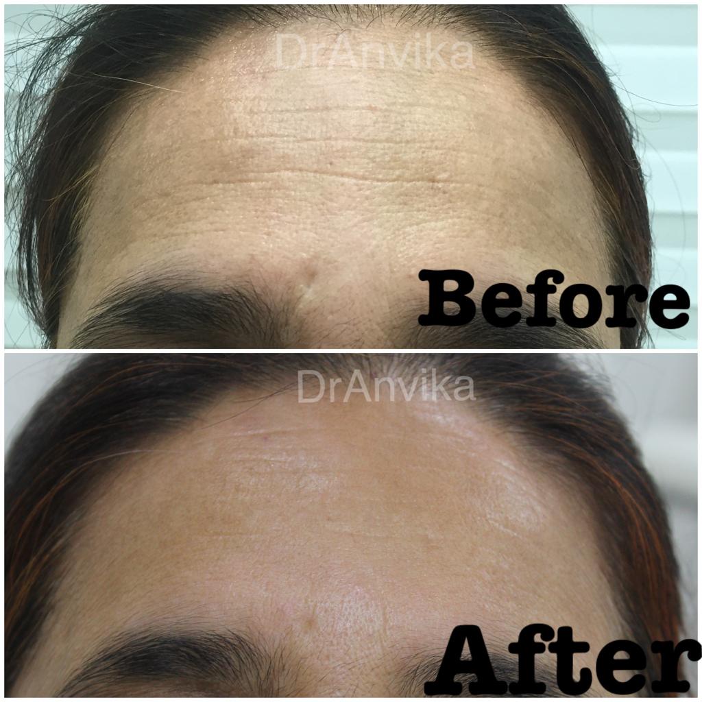Skin Glow : Vampire Facial (Microneedling & PRP) and Laser Toning(ND:Yag Q Switched Laser )