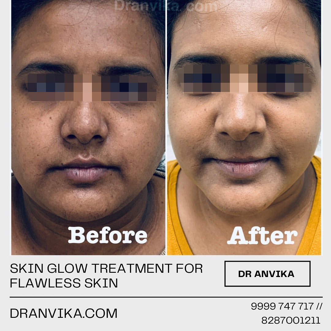 Skin glow outlet treatment