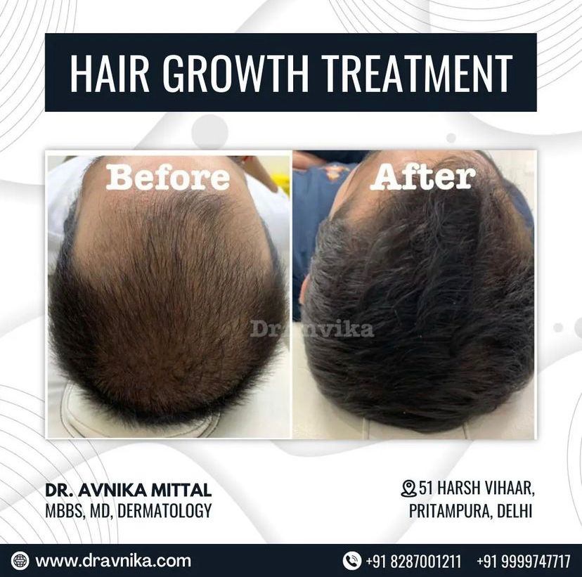 Hairfall  Treatment : PRP & Mesotherapy