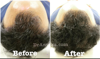 Hairfall  Treatment : PRP & Mesotherapy