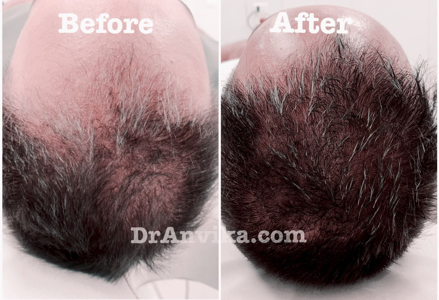 Hairfall  Treatment : PRP & Mesotherapy