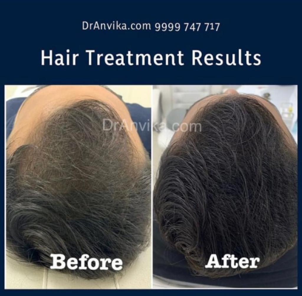 Hairfall  Treatment : PRP & Mesotherapy