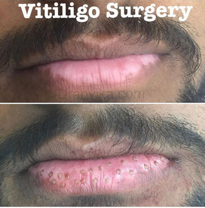 Vitiligo Surgery