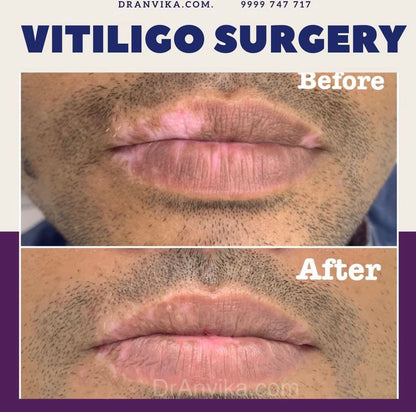 Vitiligo Surgery
