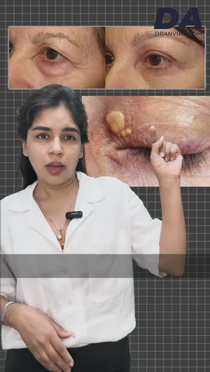 XANTOLESMA REMOVAL : Fat deposits on eyelids
