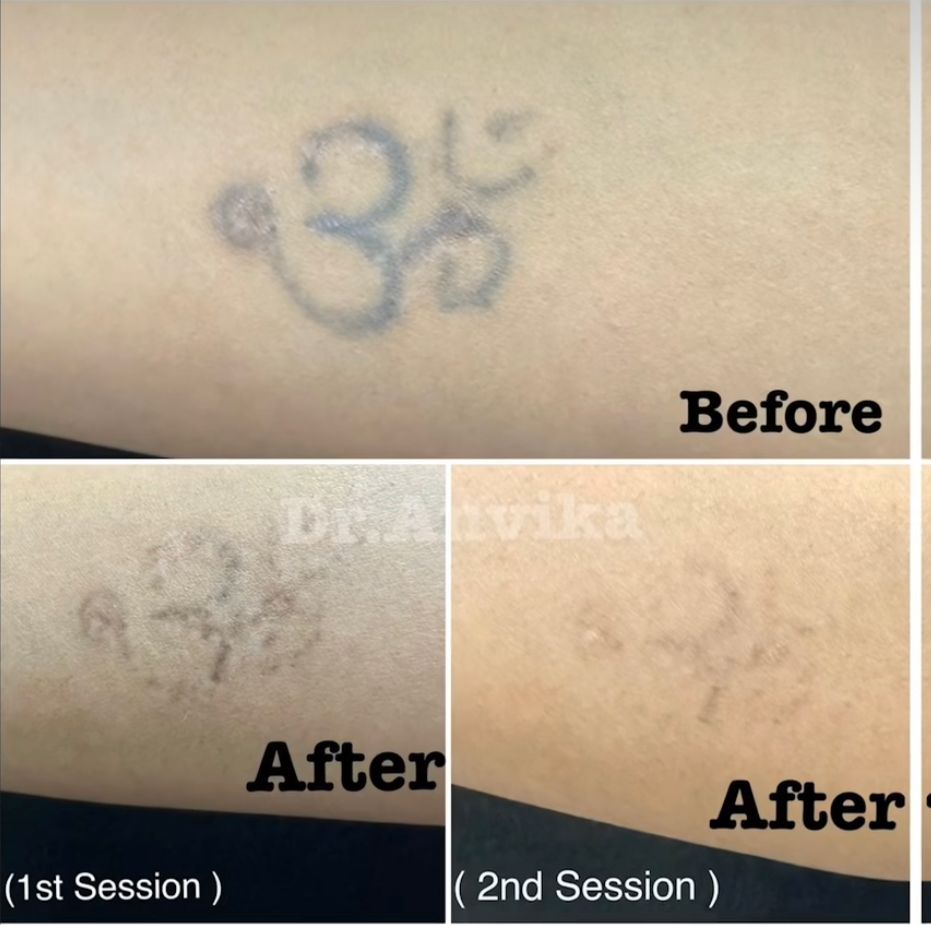 20% flat discount for laser tattoo removal till dussehra, we promise you if  your tattoo is in first Lear of your skin we ll remove it in first  session... | By Unique